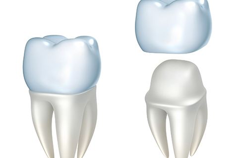 Model of dental crown covering a tooth