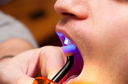 Dental light hardening dental filling