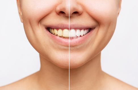 Patient's smile before and after teeth whitening